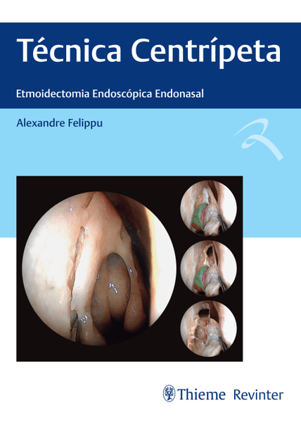 Técnica Centrípeta: Etmoidectomia Endoscópica Endonasal